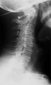 RECTIFICACIÓN CERVICAL